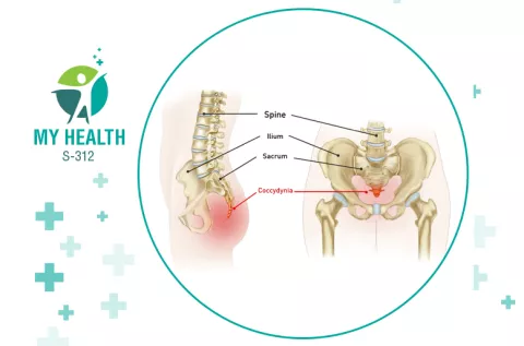 Tailbone pain: Causes, diagnosis, and relief