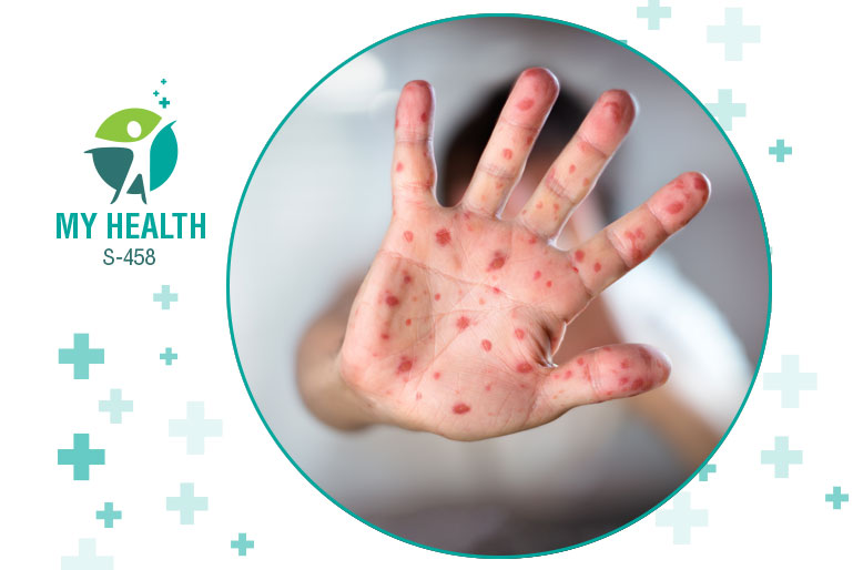 Measles symptoms treatment and prevention