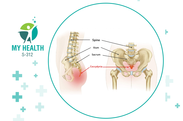 Coccyx or Tailbone Pain Treatment In Delhi and Gurgaon