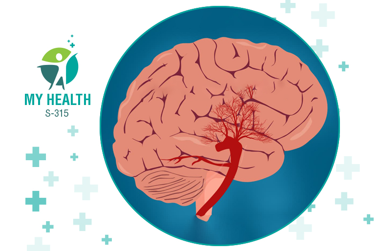 Learn all about moyamoya disease